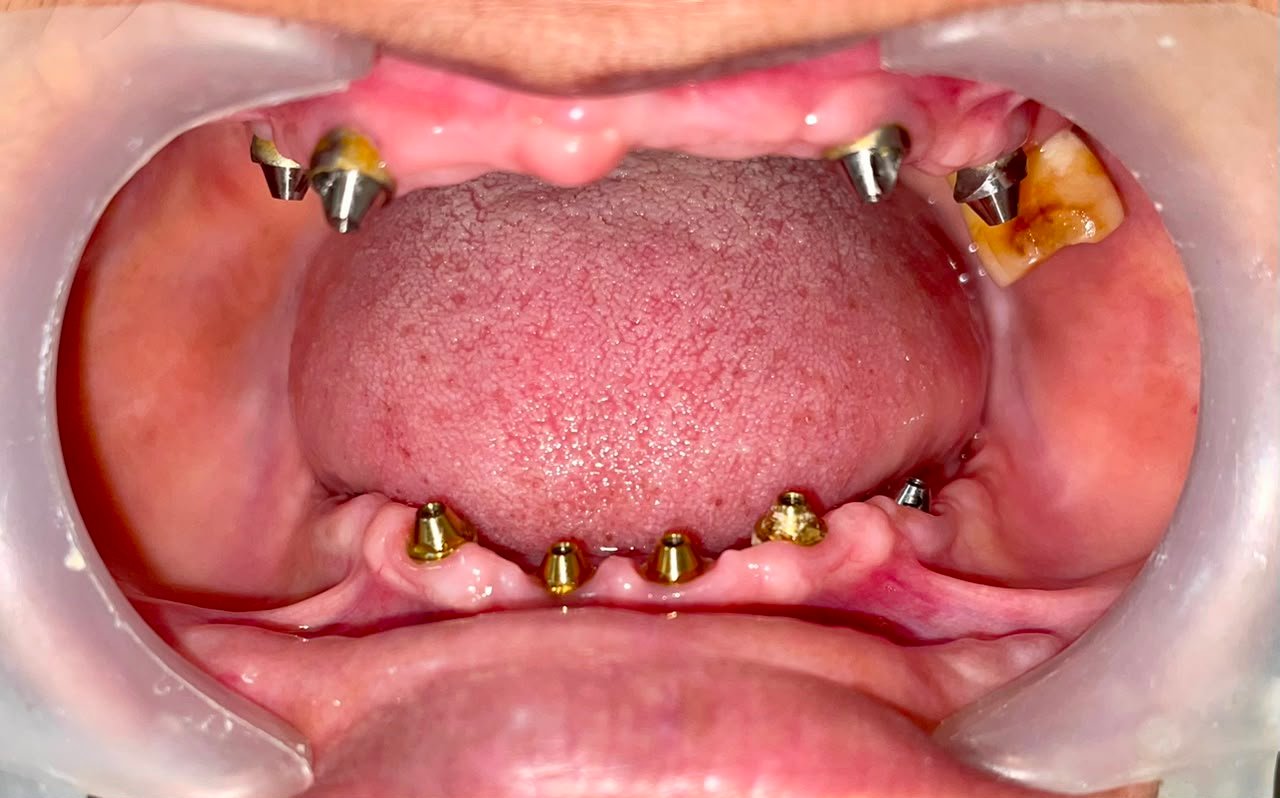 Dental Implant Abutments Stage